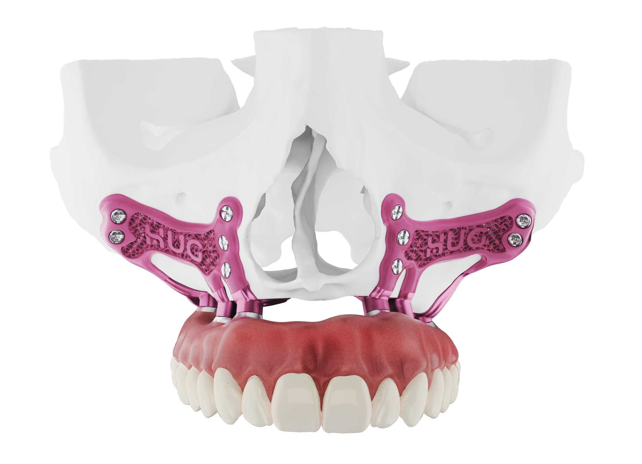 HUG_BRUGGEMAN_ENTIER.V3 Implant sous périosté hug