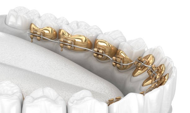 l-orthodontie-linguale Vue rapprochée d’un appareil lingual fixé sur la face interne des dents supérieures.