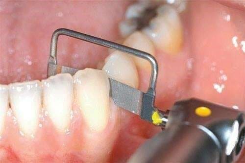 le stripping orthodontique Réalisation d’un stripping orthodontique entre deux dents à l’aide d’un instrument rotatif.