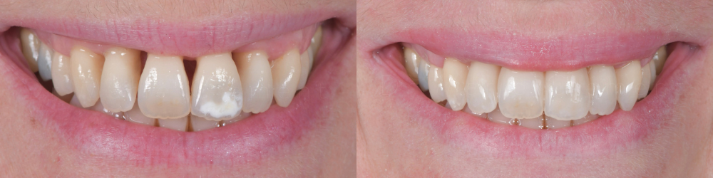 le stripping orthodontique Comparaison avant et après un traitement de stripping orthodontique sur les dents inférieures.