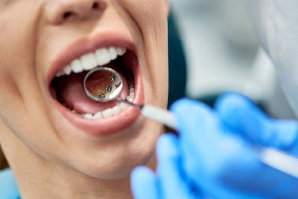 l'orthodontie linguale Gros plan sur la pose d’un appareil dentaire lingual à l’intérieur des dents d’un patient.