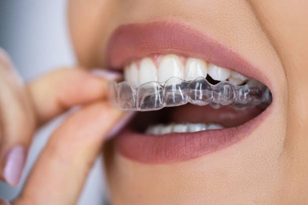 traitement par aligneurs type invialign Une patiente insère un aligneur transparent sur ses dents supérieures dans le cadre d’un traitement orthodontique discret.